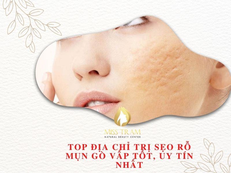 TOP Địa Chỉ Trị Sẹo Rỗ Mụn Gò Vấp Tốt, Uy Tín Nhất