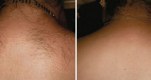 Hình ảnh trước và sau khi triệt lông vùng lưng và cổ