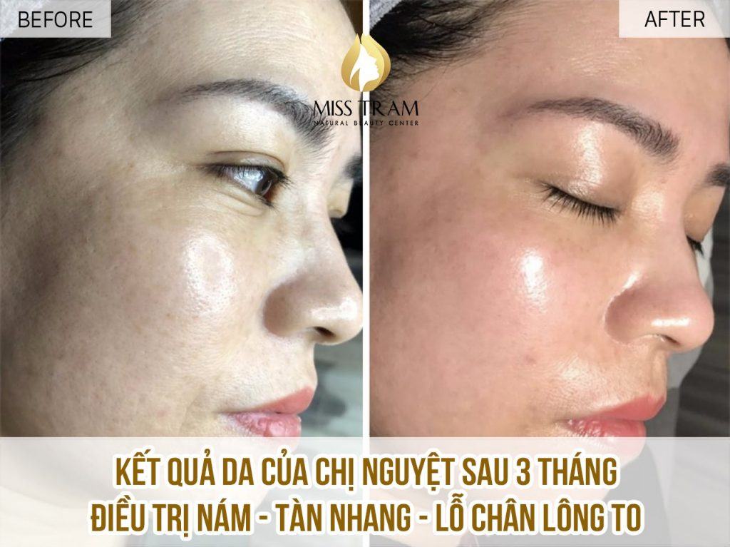 Top 9 Địa Chỉ Trị Nám Quận 11 Tốt Uy Tín Nhất Đánh dấu