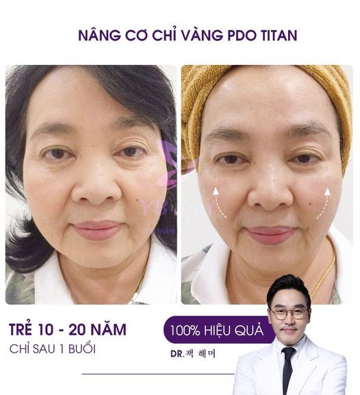 Dịch vụ nâng cô trẻ hóa da tại YB Spa Bình Tân