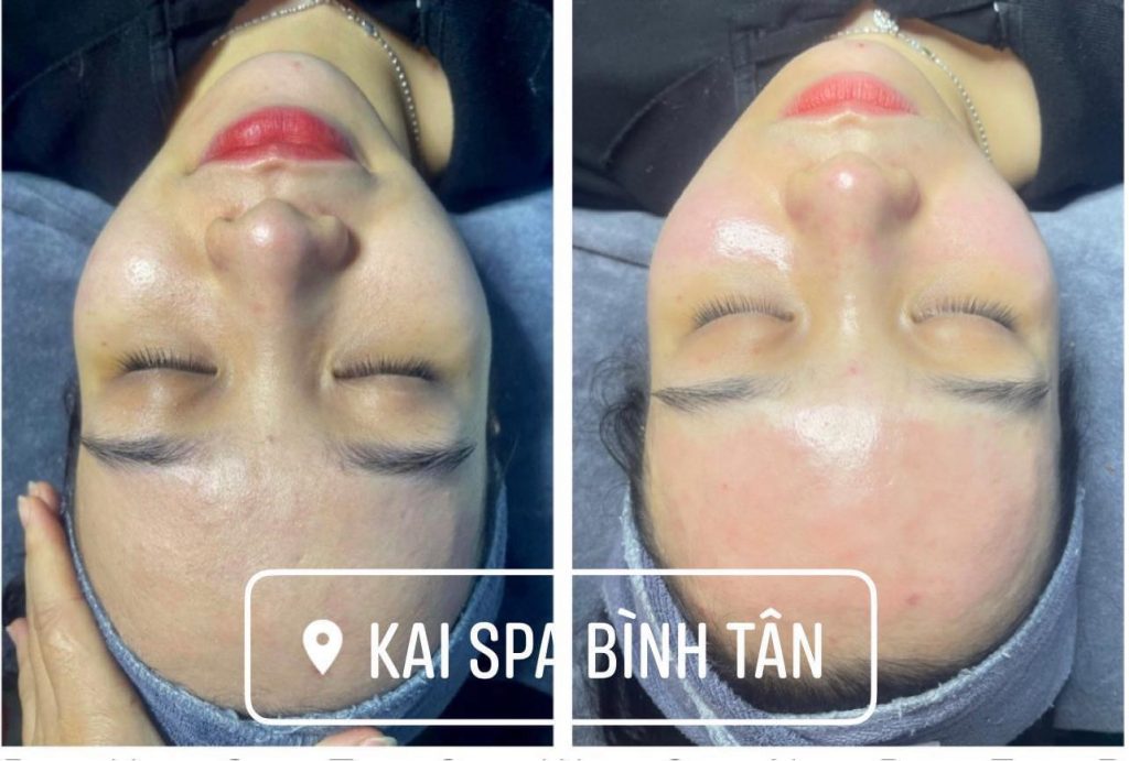 Kết quả làm đẹp môi tại Kai Spa