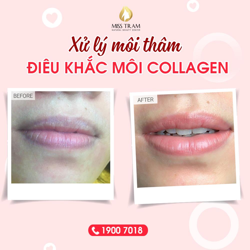 Kết quả xử lý môi thâm & điêu khắc môi Collagen 