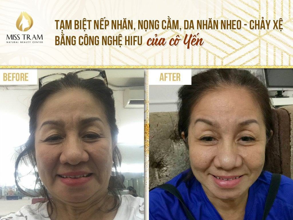 Kết quả xóa nếp nhăn da, nọng cằm bằng công nghệ HIFU