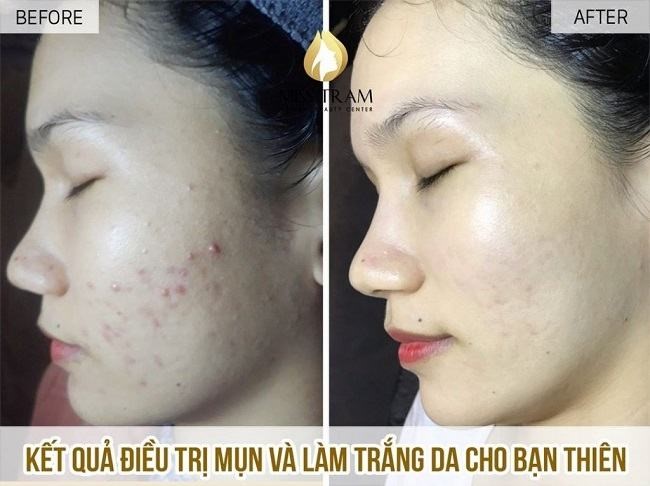 Kết quả điều trị mụn mặt & làm trắng da