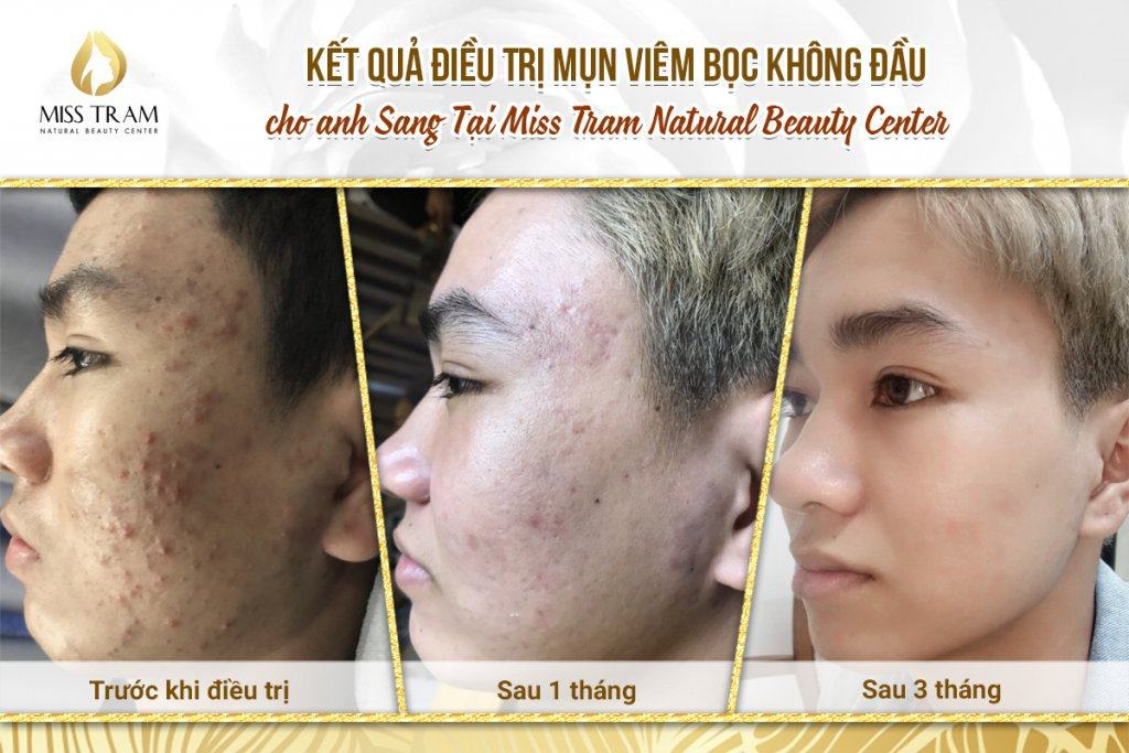 Top 9 Best Places to Treat Acne Scars in District 10