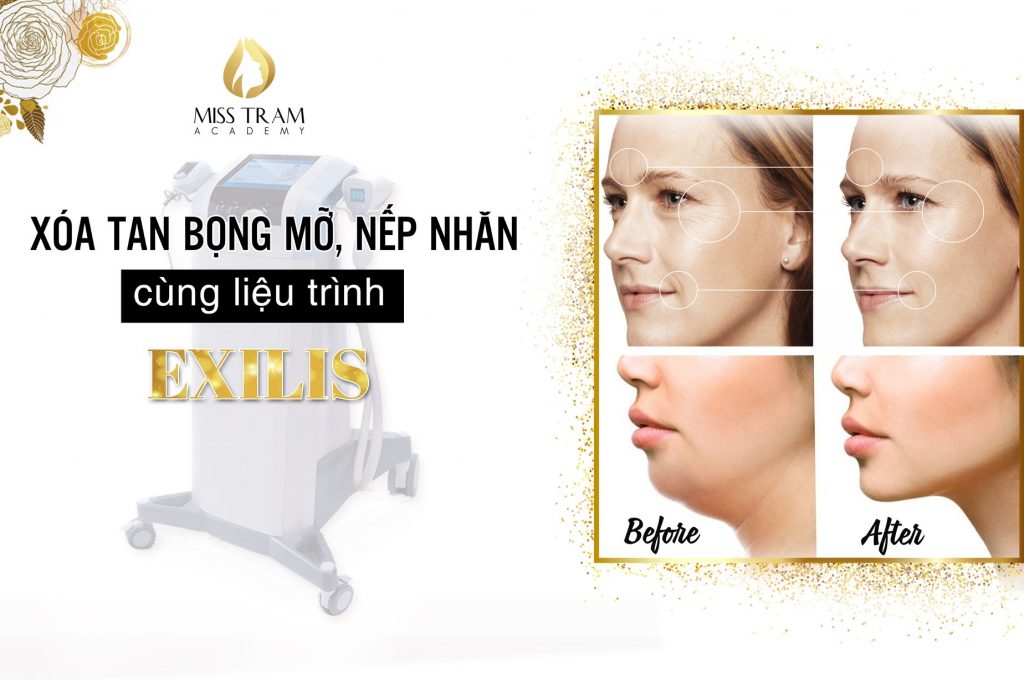 Xóa tan bọng mỡ, nếp nhăn với liệu trình EXILIS