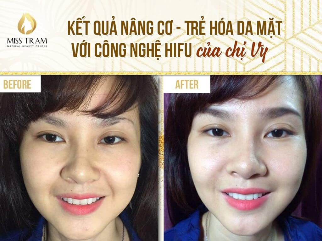 Kết quả nâng cơ trẻ hóa da bằng công nghệ HIFU