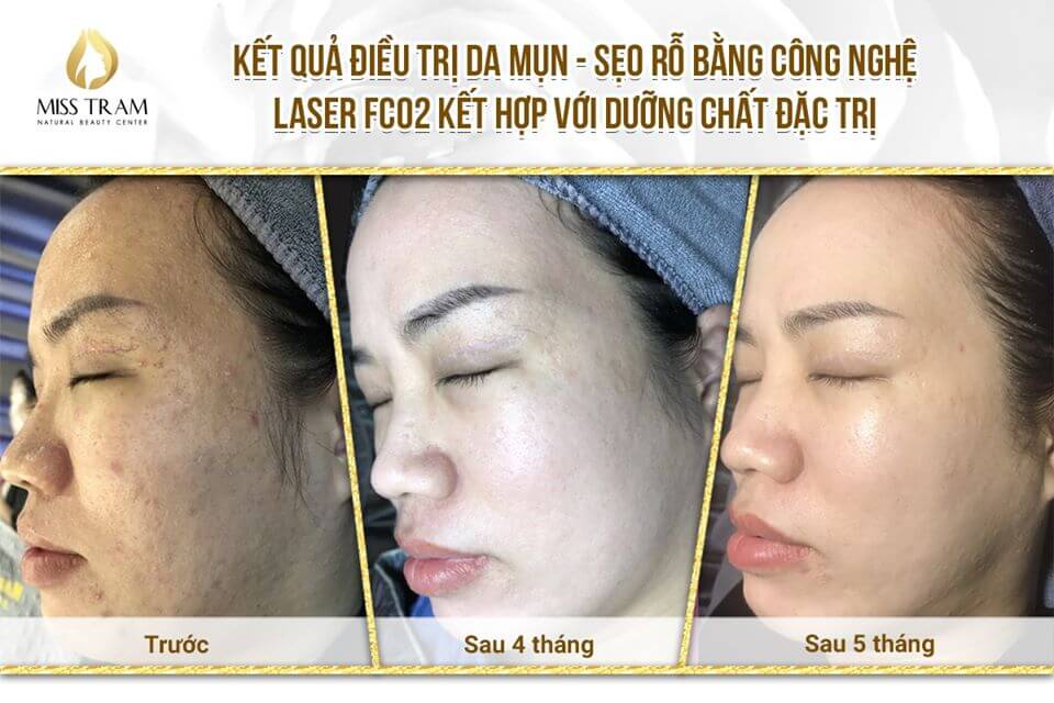 Top 7 Địa Chỉ Trị Sẹo Rỗ Mụn Huyện Cần Giờ Tốt Uy Tín Nhất Lộ diện