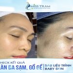 Check Kết Quả Da Sạm, Gồ Ghề Sau Liệu Trình Baby Skin Như Thế Nào?