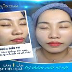 Làm 1 Lần Hiệu Quả Trị Thâm Mắt Rõ Rệt