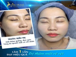 Làm 1 Lần Hiệu Quả Trị Thâm Mắt Rõ Rệt