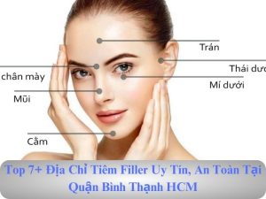 tiêm filler 5 điểm