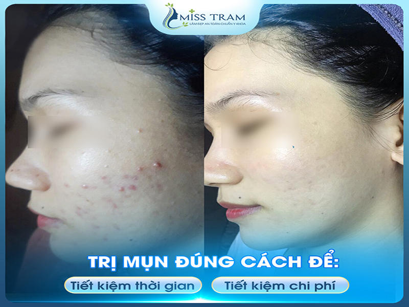 Trị Mụn Đúng Cách Để Tiết Kiệm Thời Gian, Chi Phí