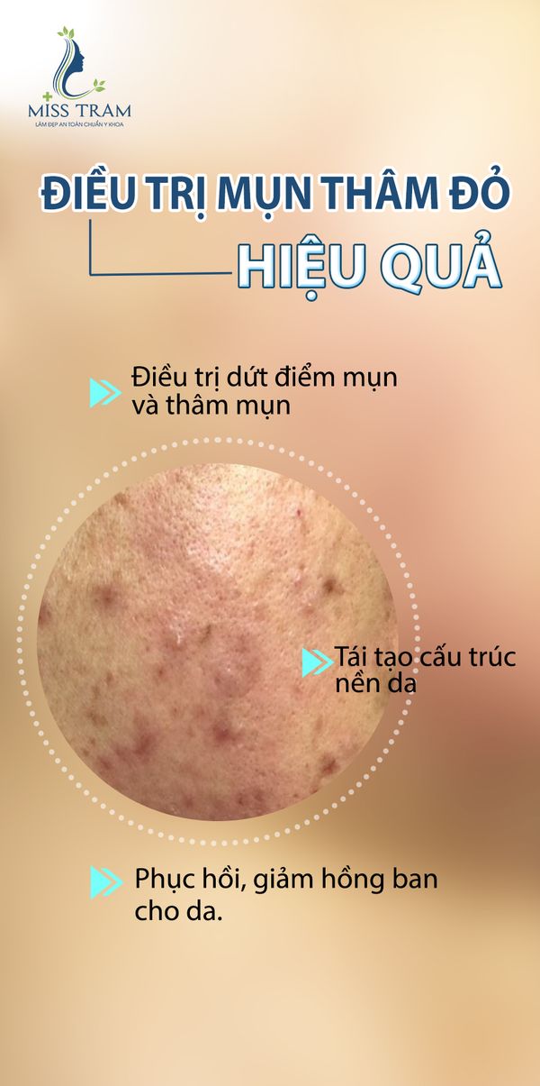 Bí Quyết Điều Trị Mụn Thâm Đỏ Và Sở Hữu Làn Da Perfect Skin Tóm tắt