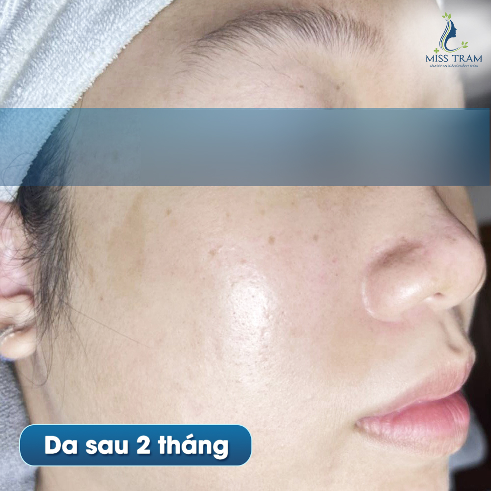 Bí Quyết Điều Trị Mụn Tại Miss Tram Spa: Làn Da Khỏe Đẹp Trong Tầm Tay Lộ diện