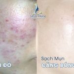 Kỳ Vọng Từ Việc Điều Trị Mụn Tại Miss Tram: Xóa Mụn Thâm, Da Sáng Mịn Căng Bóng. Nghiên cứu
