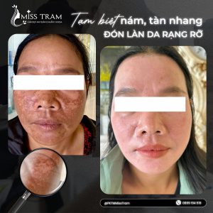 Xoá Nám Tàn Nhang An Toàn Tại TPHCM – Bí Quyết Lấy Lại Làn Da Tươi Trẻ Bạn đã nghe