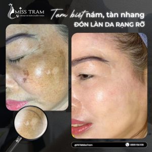 Top Địa Chỉ Trị Nám Da Chất Lượng Quận 3 Được Khách Hàng Tin Tưởng Nghiên cứu