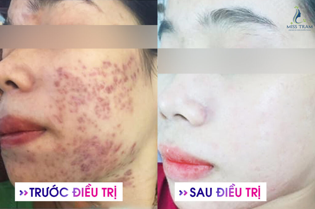 Chăm sóc da điều trị mụn an toàn quận 3 Ghi nhớ