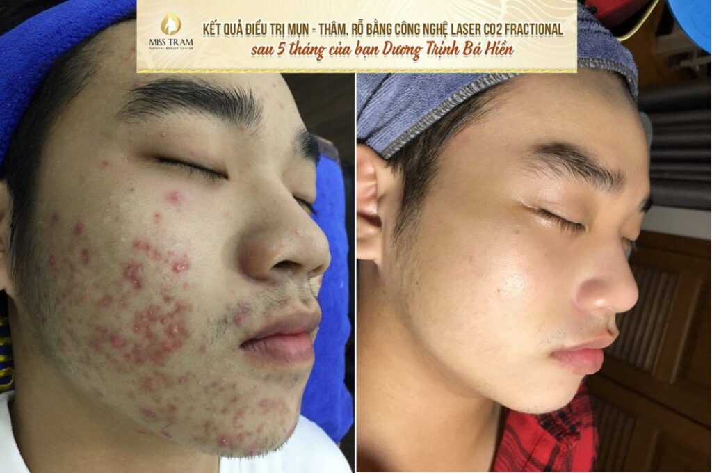 Điều Trị Mụn Chuẩn Y Khoa Tại Miss Trâm – 3 Nhóm Mụn Chính & Giải Pháp Chăm Sóc Da Hiệu Quả Kiểm duyệt