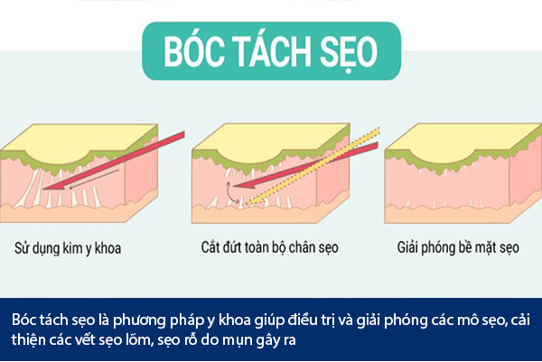 Vĩnh Biệt Sẹo Rỗ: Đột Phá Công Nghệ Laser CO2 Fractional Tại Miss Tram! Nhấn mạnh