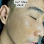 Điều Trị Sẹo Rỗ Tại Miss Tram Spa - Giải Pháp Hiệu Quả Cho Làn Da Sáng Mịn Nghiên cứu