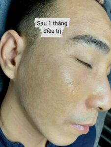 Điều Trị Sẹo Rỗ Tại Miss Tram Spa - Giải Pháp Hiệu Quả Cho Làn Da Sáng Mịn Phổ biến