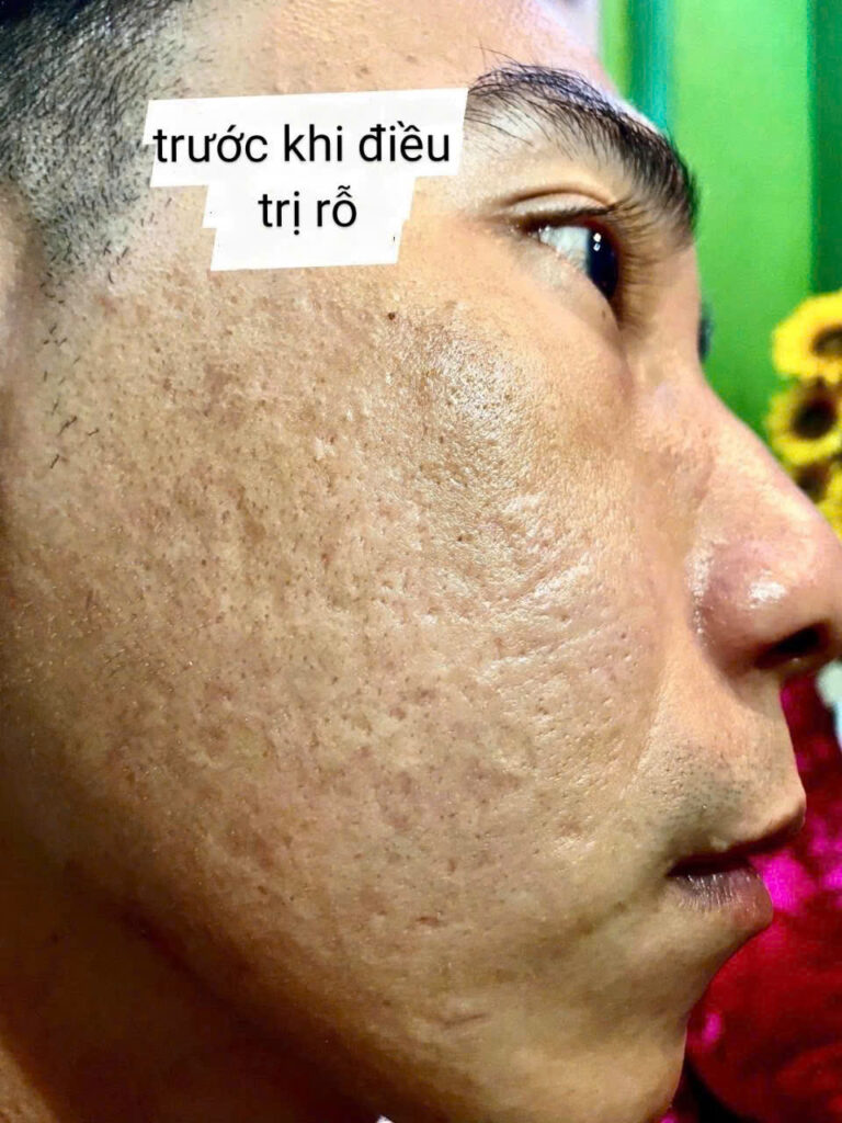Điều Trị Sẹo Rỗ Tại Miss Tram Spa - Giải Pháp Hiệu Quả Cho Làn Da Sáng Mịn Review