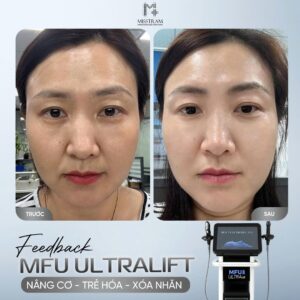 Trẻ Hóa Da Thần Tốc Với Công Nghệ MFU Ultralift: Bí Quyết Lấy Lại 10 Năm Tuổi Xuân Bạn đã nghe