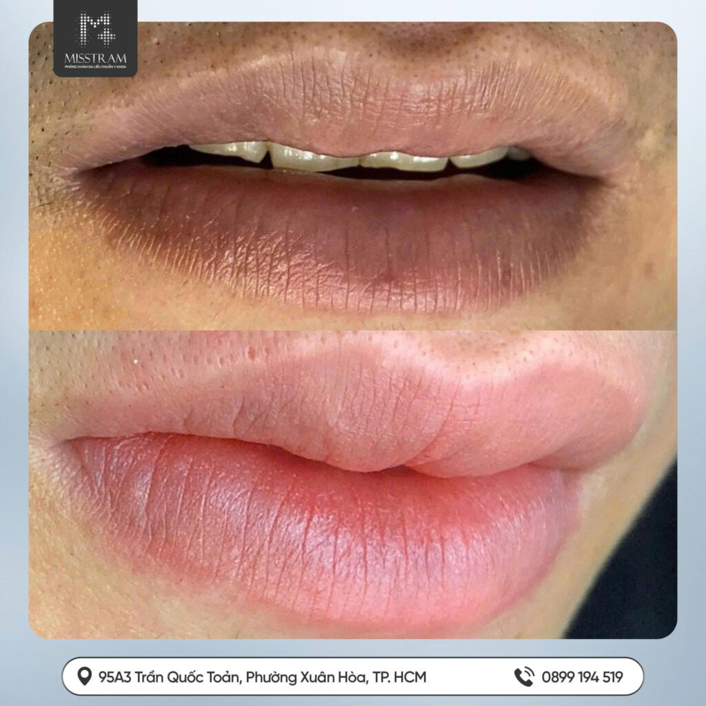 Sự Thật: 9/10 Người Cần Khử Thâm Trước Khi Phun Môi? Giải Pháp Từ Miss Trâm Chuyên gia