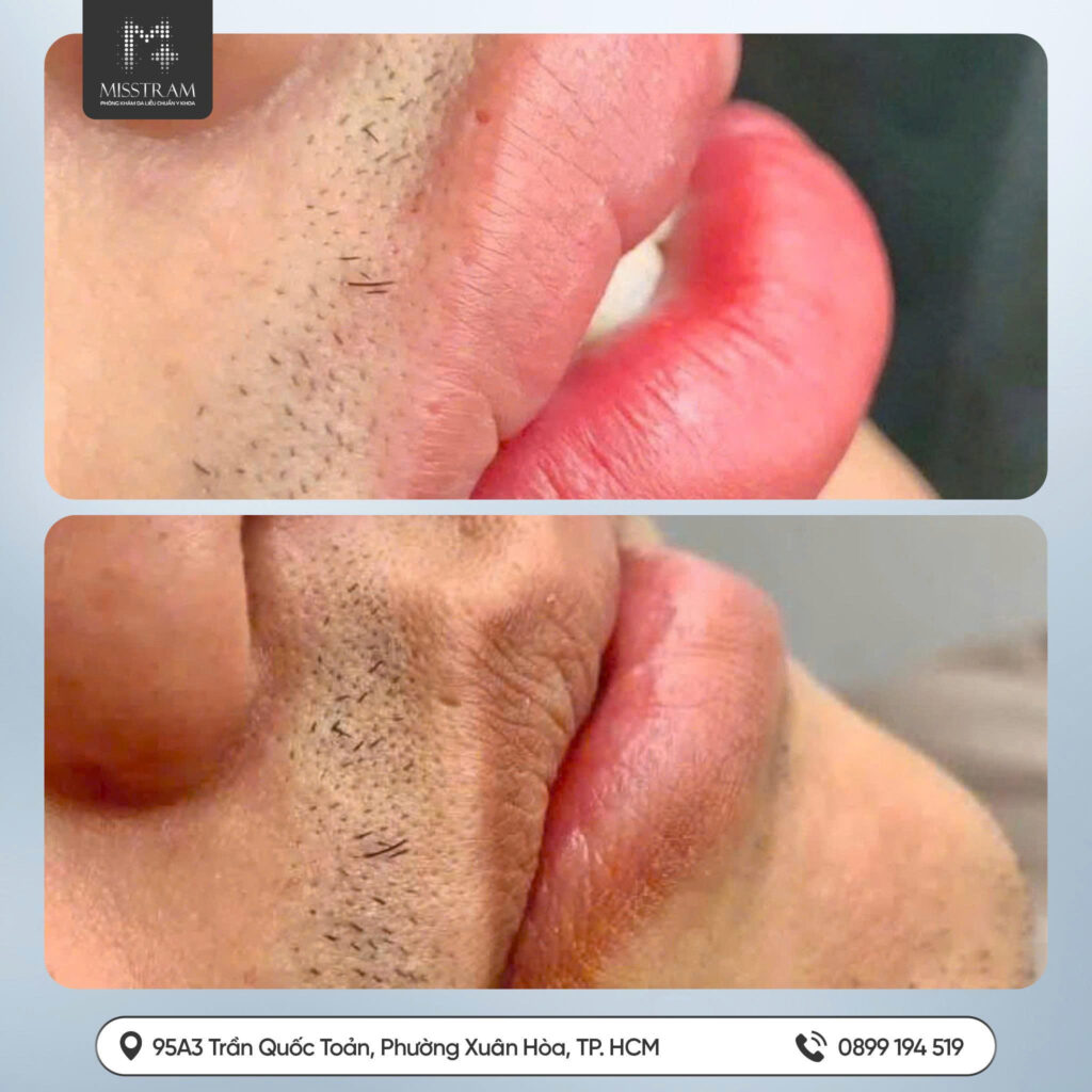 Giải Mã Lý Do 10 Người Đi Phun Thì 9 Người Môi Thâm & Cách Khắc Phục Tiệt Để Chuyên gia