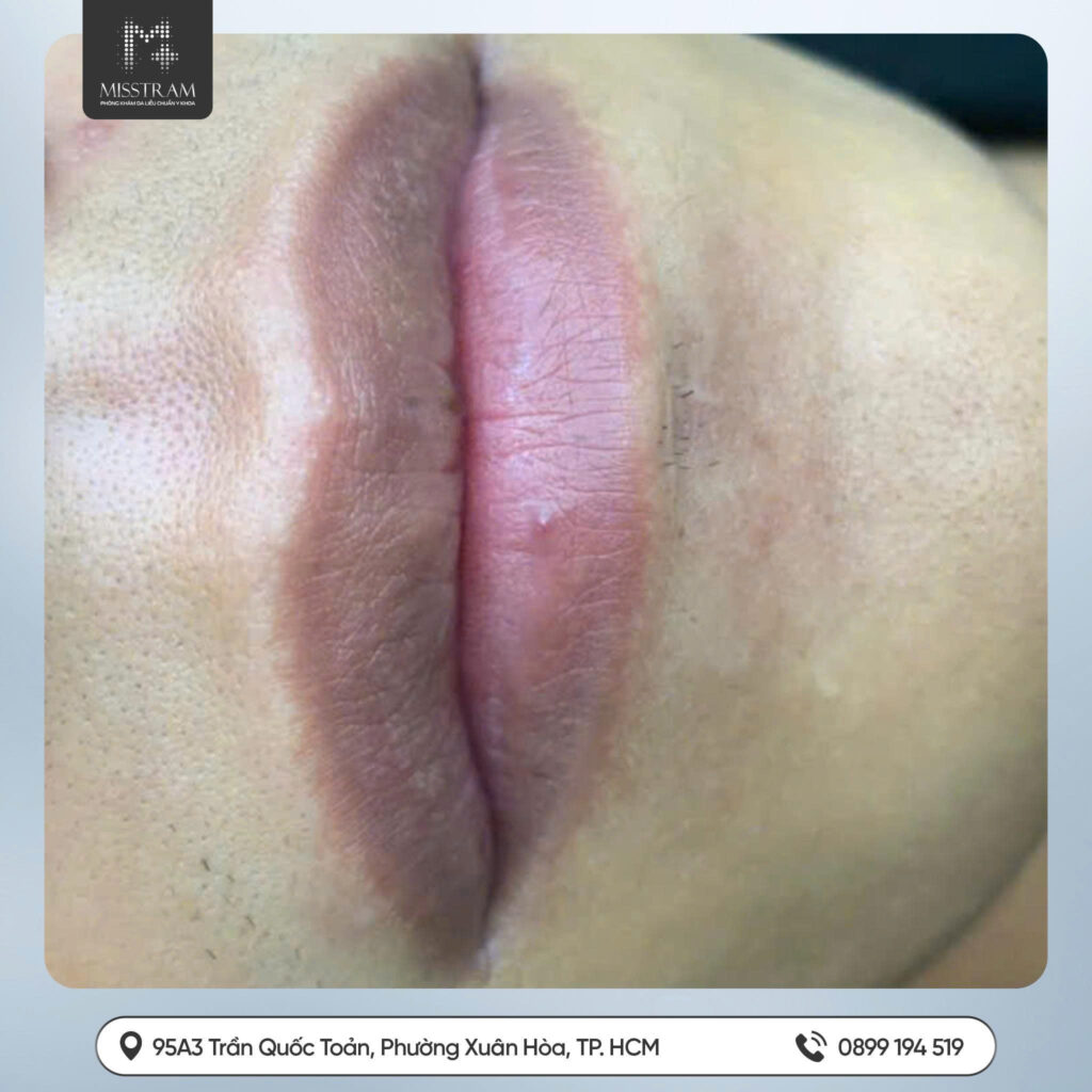 Giải Mã Lý Do 10 Người Đi Phun Thì 9 Người Môi Thâm & Cách Khắc Phục Tiệt Để Nên xem