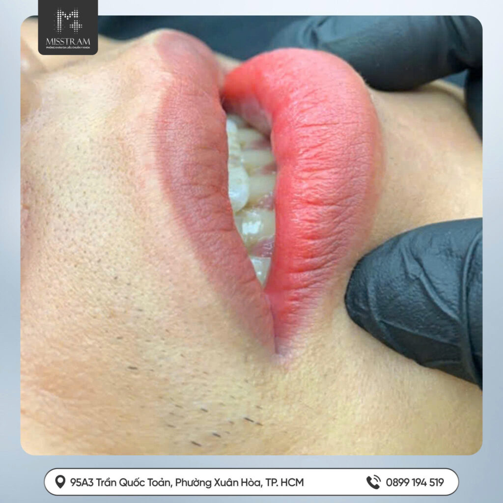 Giải Mã Lý Do 10 Người Đi Phun Thì 9 Người Môi Thâm & Cách Khắc Phục Tiệt Để Nên xem